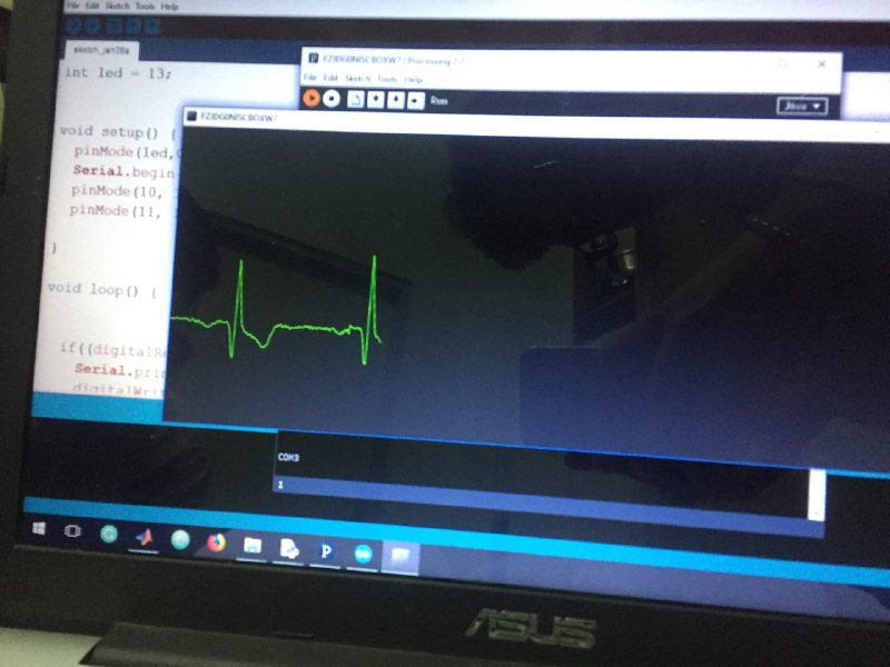 ECG trace showing an extra deflection after the QRS complex